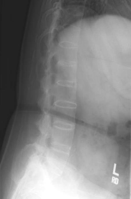 Orthobullets Ankylosing Spondylosis As Is A Facebook