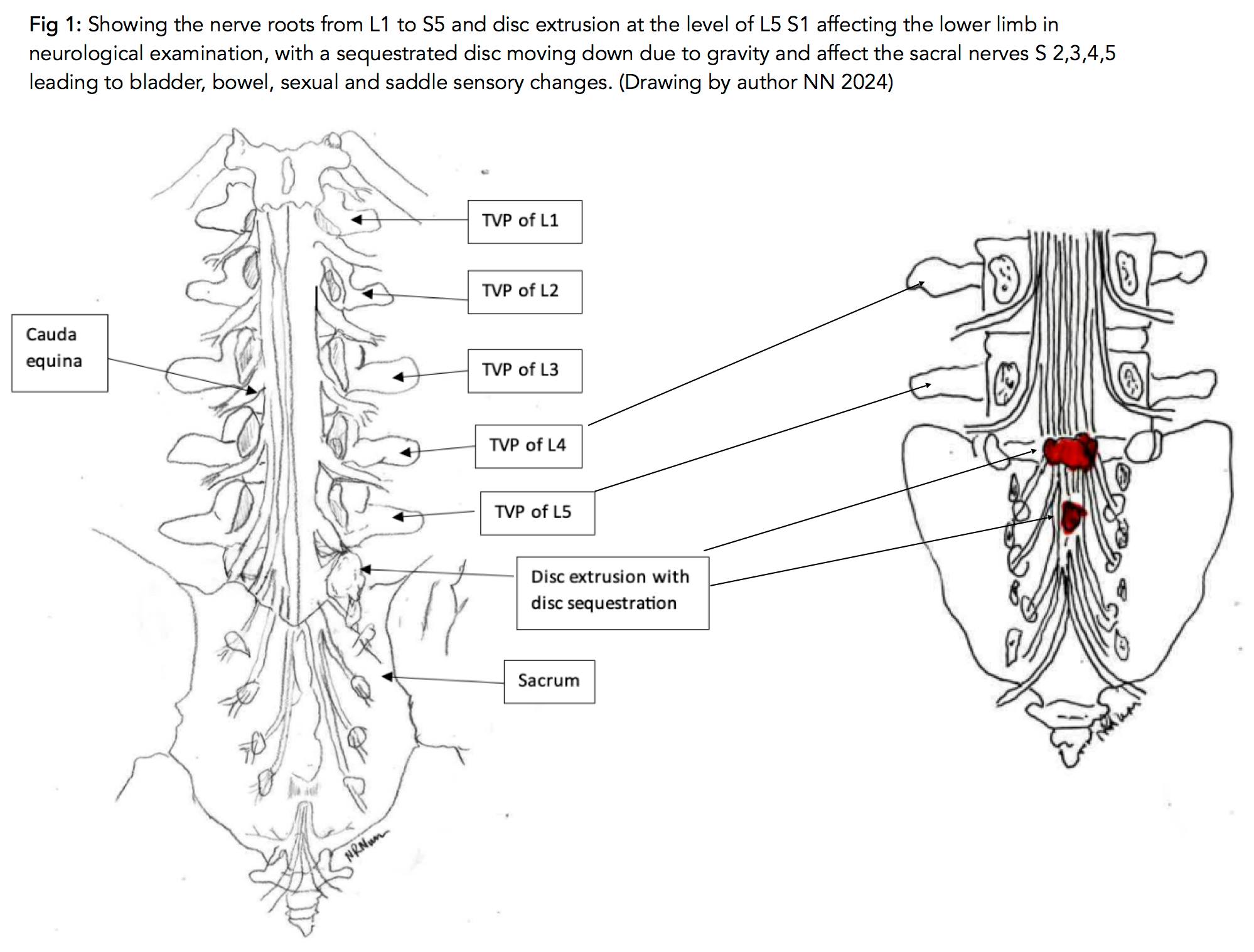 Chiropractic students recognize cauda equina syndrome signs