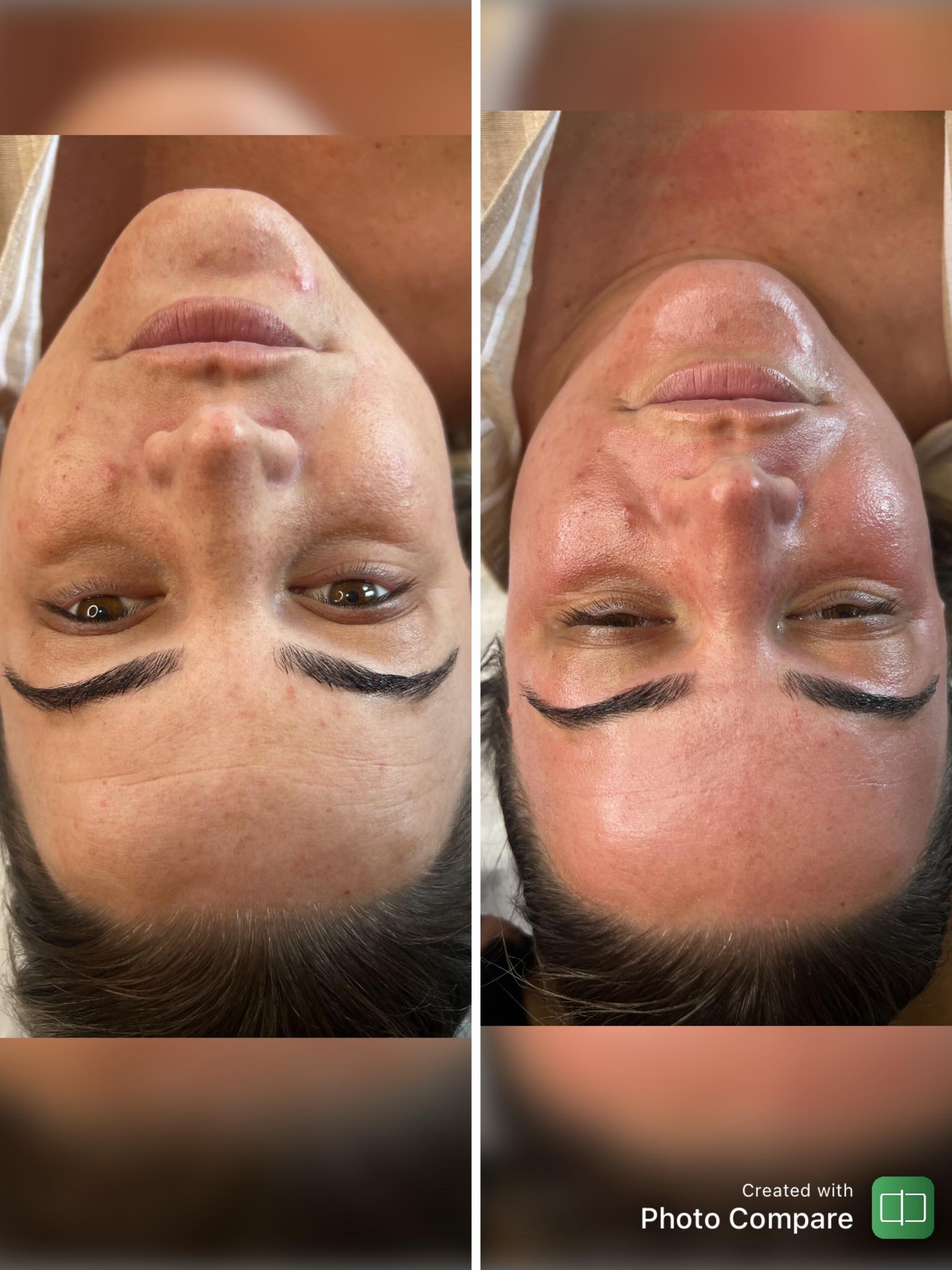 glutathione microneedling before and after The amazing results of our Treatment✨ The pictures speak volumes- consistent treatments show results👏 Call 0161 768 7674 to book in a free consultation with our team start your skin effective whitening serum 2025 WADA Prohibited List Buy More & Save:Buy 3 - R 945 (Save 20%)
