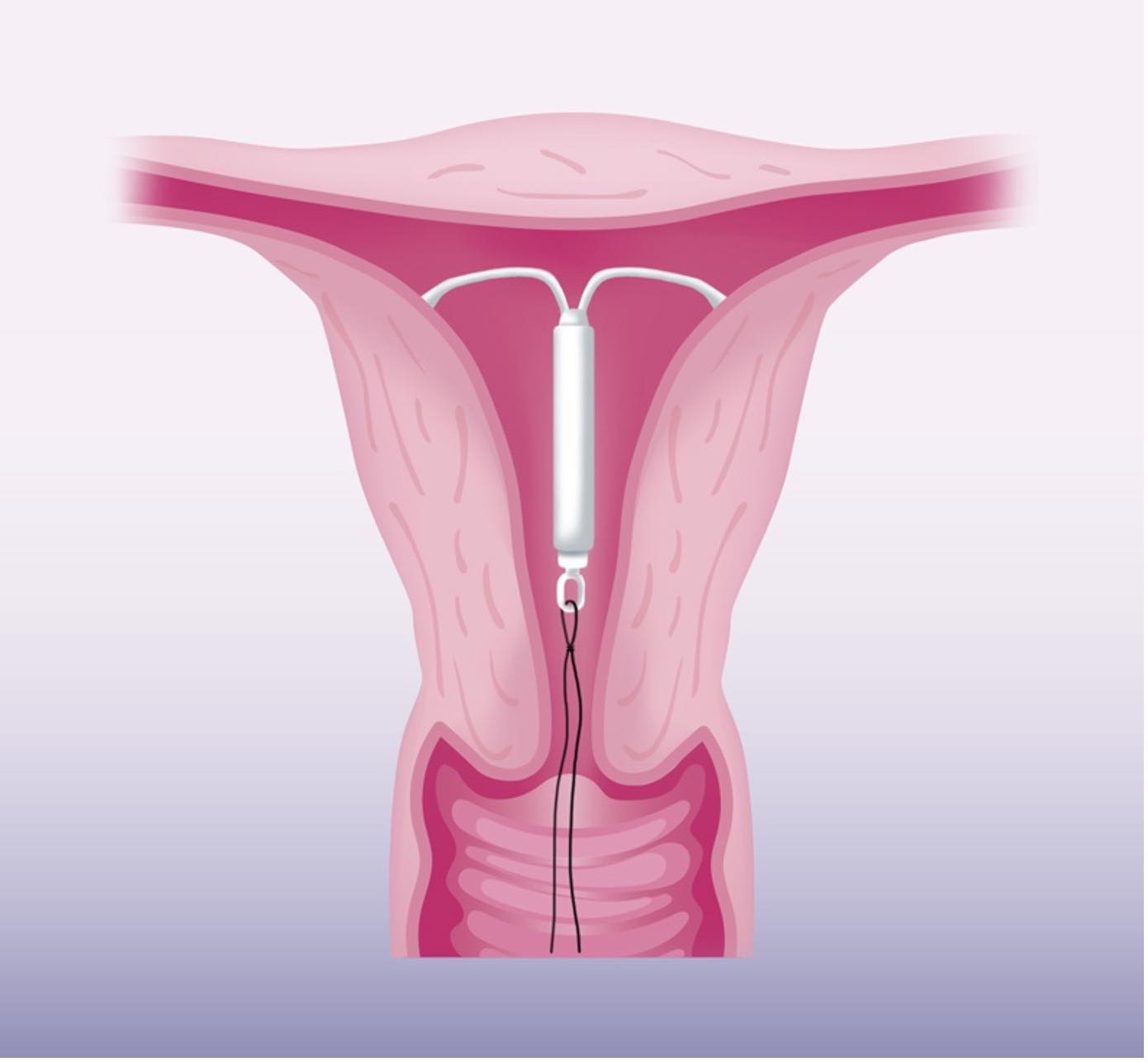 What is Mirena's effectiveness for endometriosis?