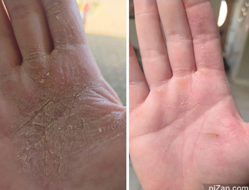 Mallory - “10 DAYS using InfuseHA!! 🤯🤯🤯 My skin feels softer, smoother ...