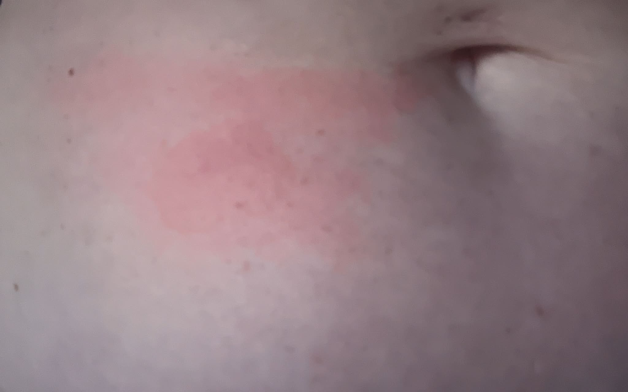 Allergic reactions to Zepbound injection sites, is it the formula or delivery method?