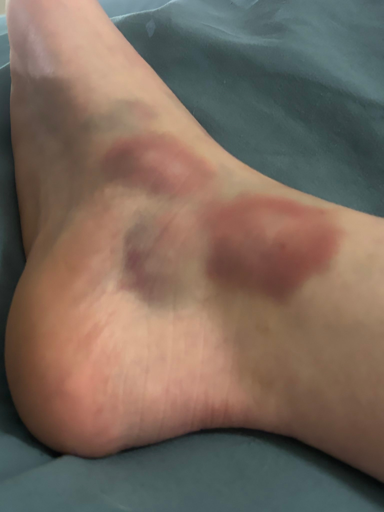 What causes instant bruising after an injury?