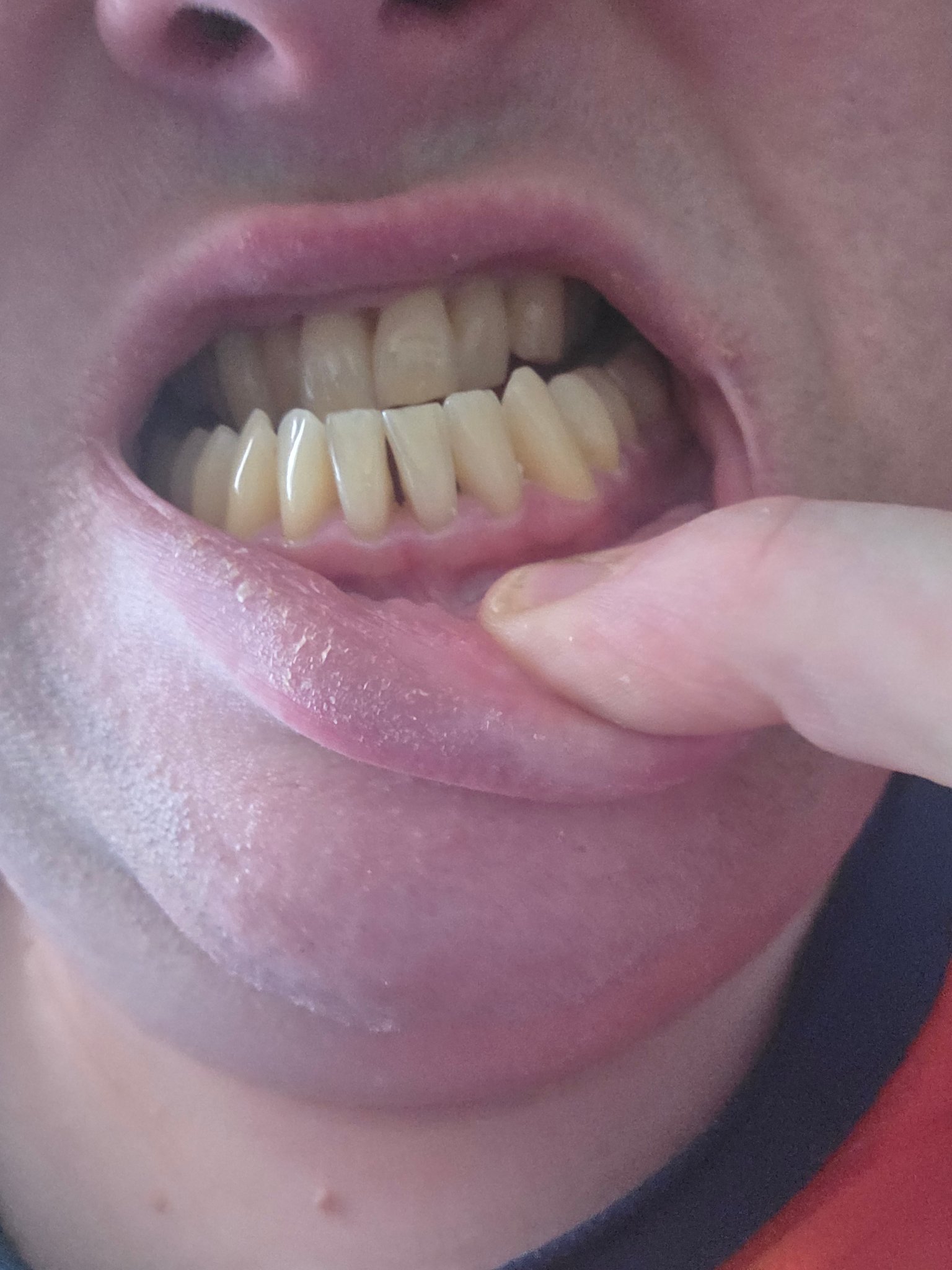 vitamin b12 injection reddit AMA: How Might Nicotinamide Riboside (NR) Impact Your Skin? Doctor said this is normal?