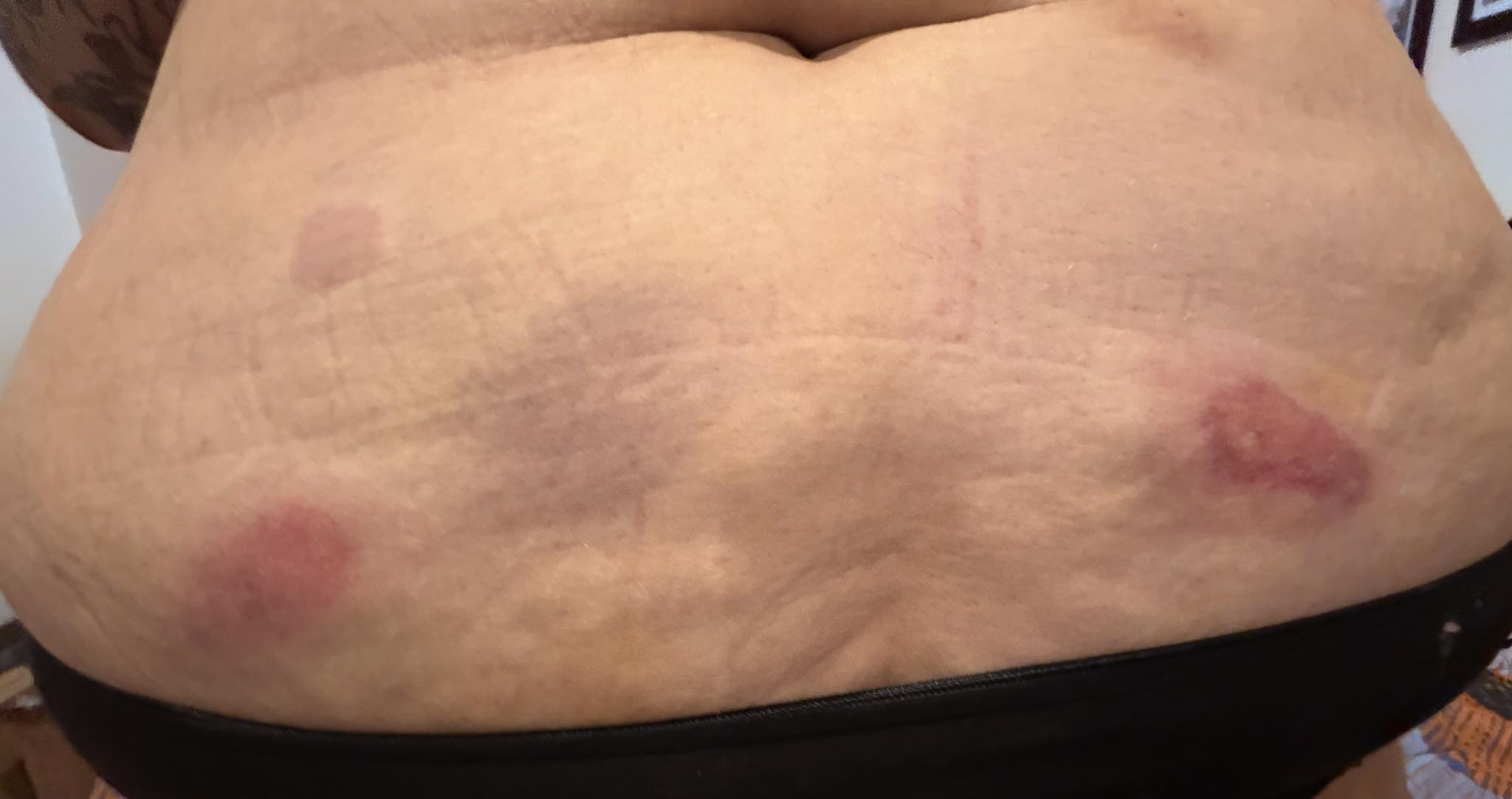 ghk-cu bruising I've been doing ghk with no issues, started 2 weeks ago. I've been using a 1” 💉 and diluting it with BAC . Over this past week I've been having issues puncturing Vitamin B12 Injection, 50 non greasy serum Volume:100mg – 5 vial lab pack (Save 5%)