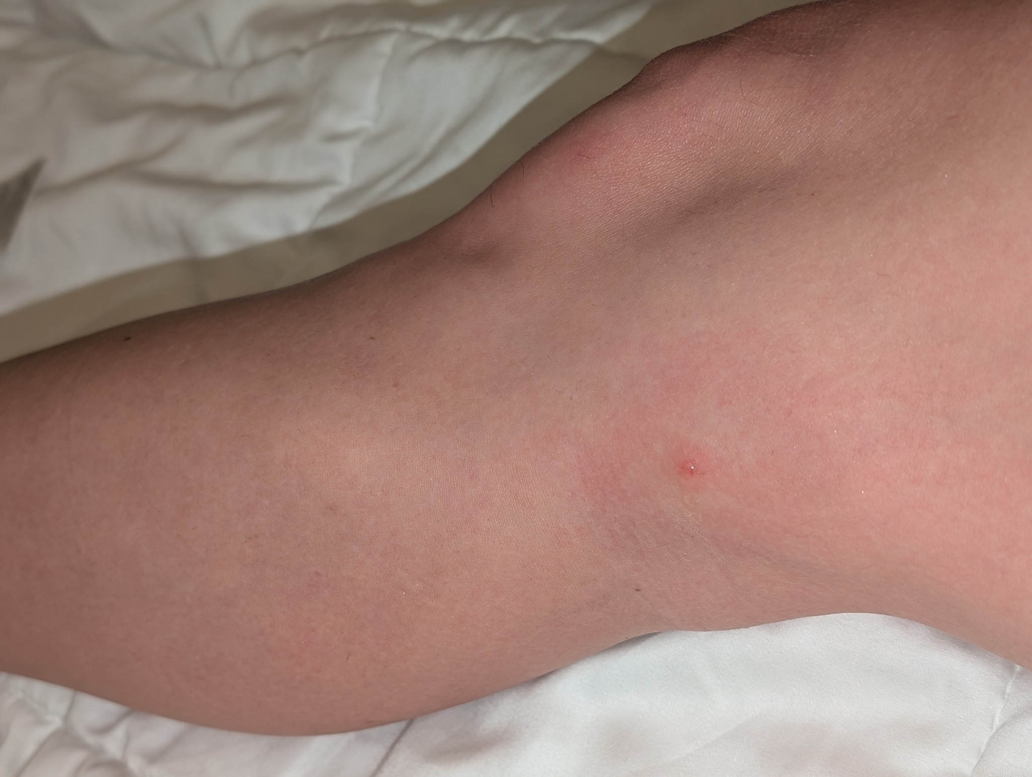Diana - PSA: That's not a mosquito bite. That's the bullseye 🎯 ...