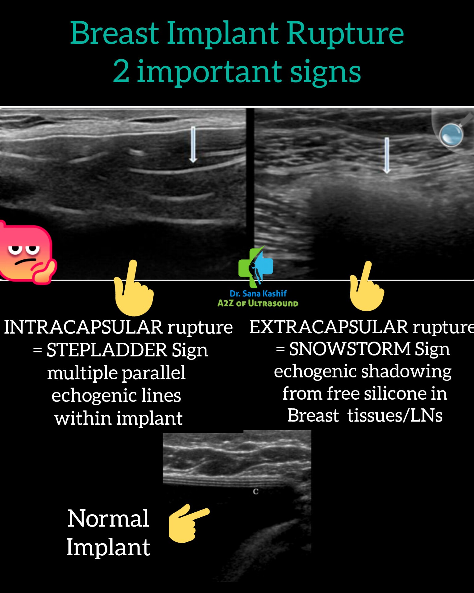 Radiology Made Easy | ♦️Breast Implant Rupture: 2 important sonographic ...