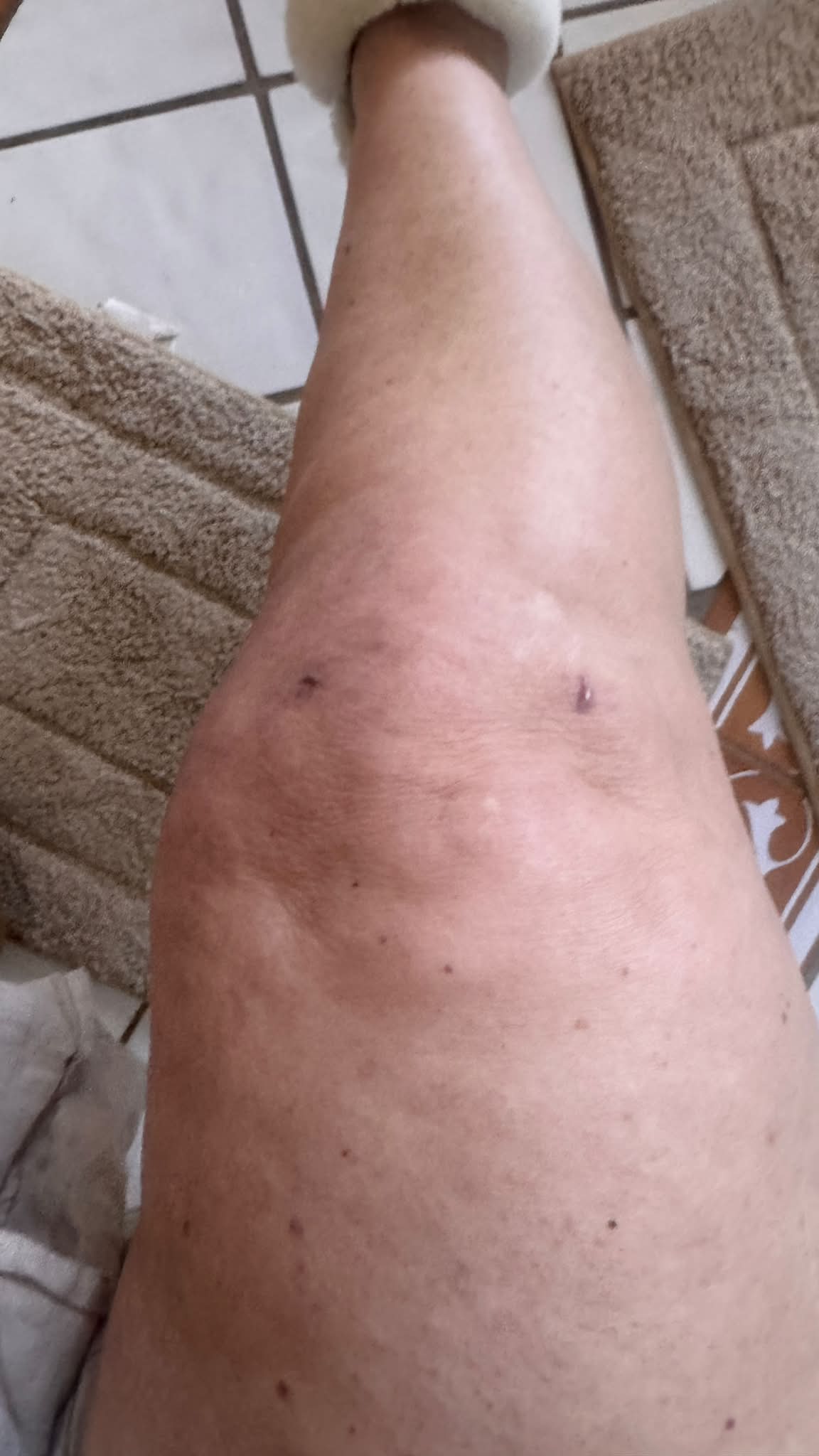 bpc 157 meniscus injury For those that use BPC-157: I did two sub Q cycles immediately post op. I am considering it again, now at 11 weeks post op. What do you think? Worth it? Too Poultry Full/Deposit:Deposit nad+ mots c 5