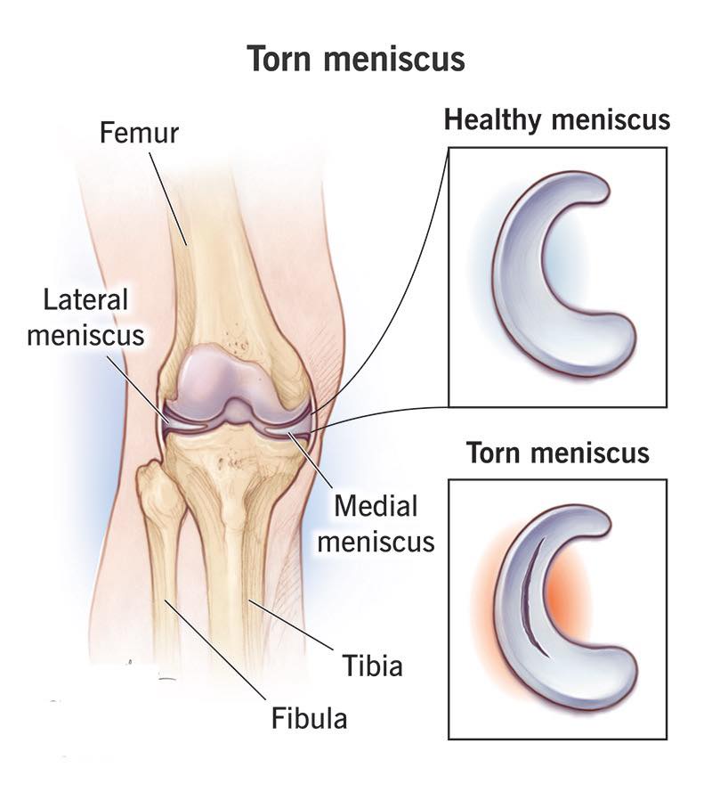 How effective is peptide therapy for torn meniscus recovery?