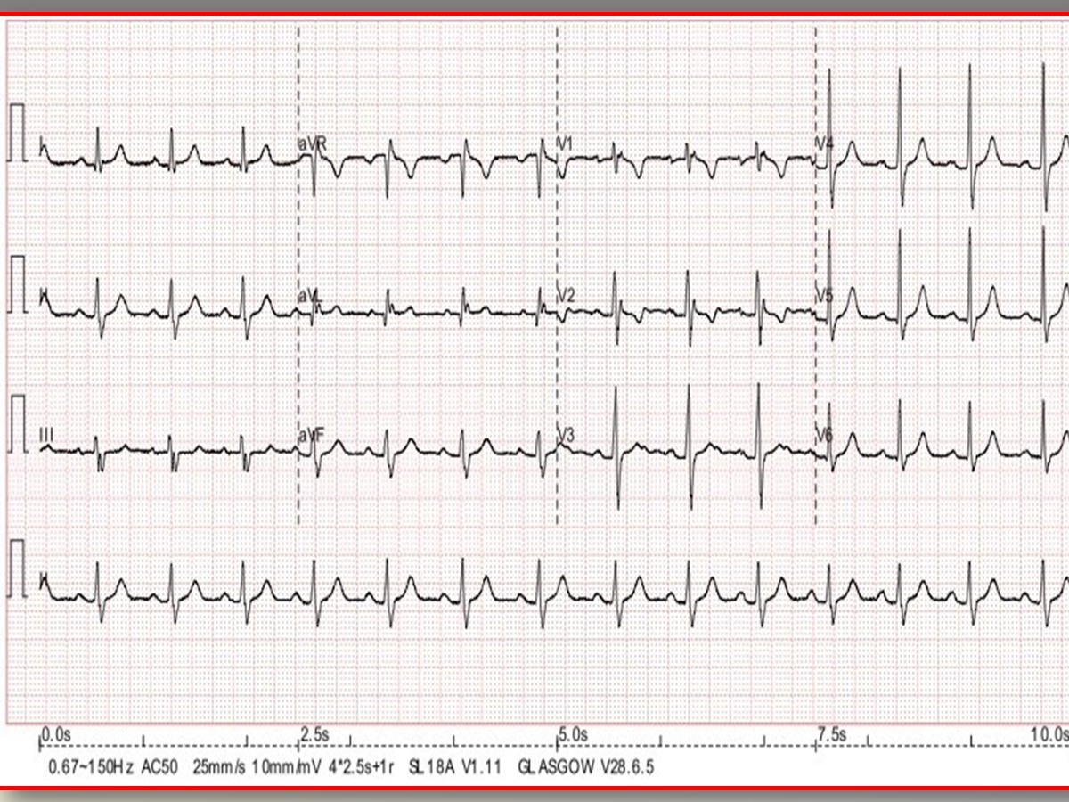 can glutathione cause palpitations Severe pulmonary infections, including COVID-19, community-acquired pneumonia, influenza, and Pneumocystis pneumonia, are a leading of death among adults worldwide. Pulmonary infections in critically ill patients may cause septic shock, acute Can Glutathione Cause Heart Palpitations?