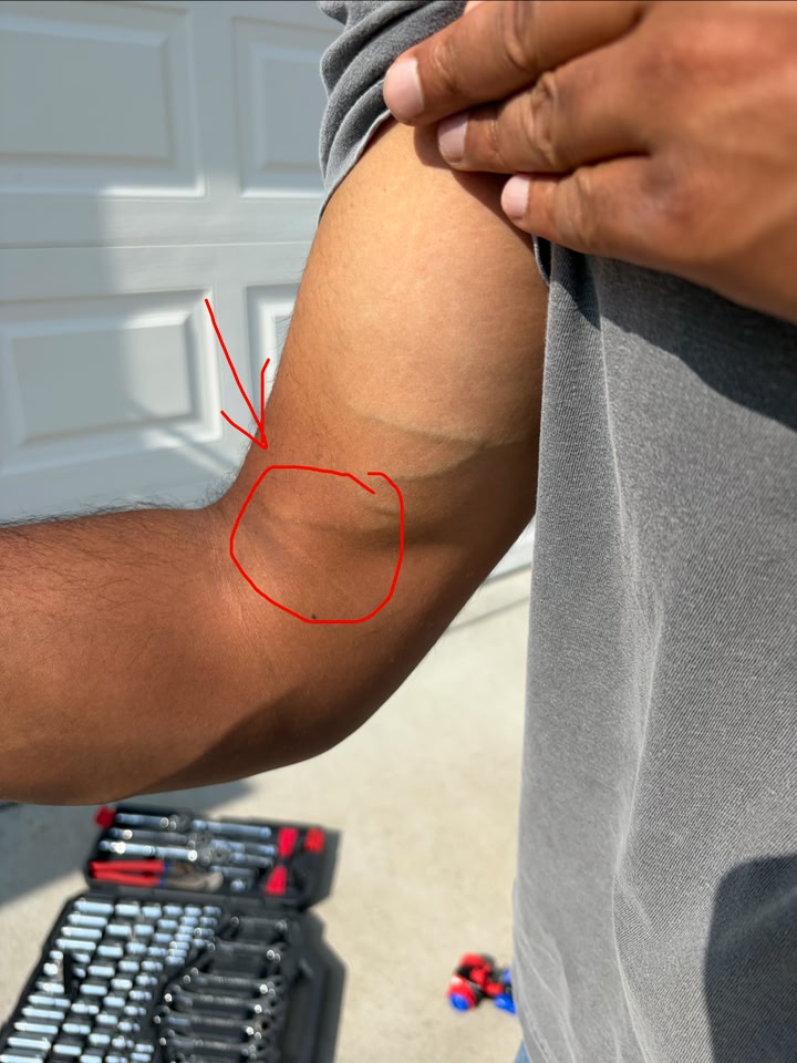bpc 157 bicep tear Tips for distal tendon repair surgery recovery? Body Protective Compound - tesamorelin Flavor:Mocha