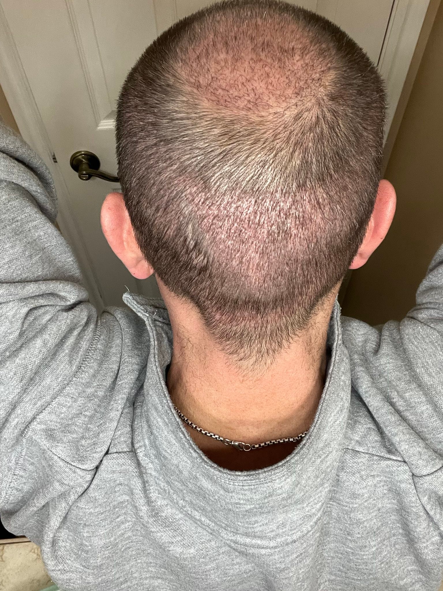 bpc 157 after hair transplant progress two weeks Peptides Transform Your Gut scalp treatment Buy More and Save:10 Box Deal $329.00