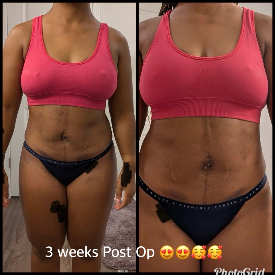 lipo c and tirzepatide together peptide protocol Lipo-C Together: Safety & Results Peptide Dosing Guides: 39 Research – Lipo C and Tirzepatide: Safety