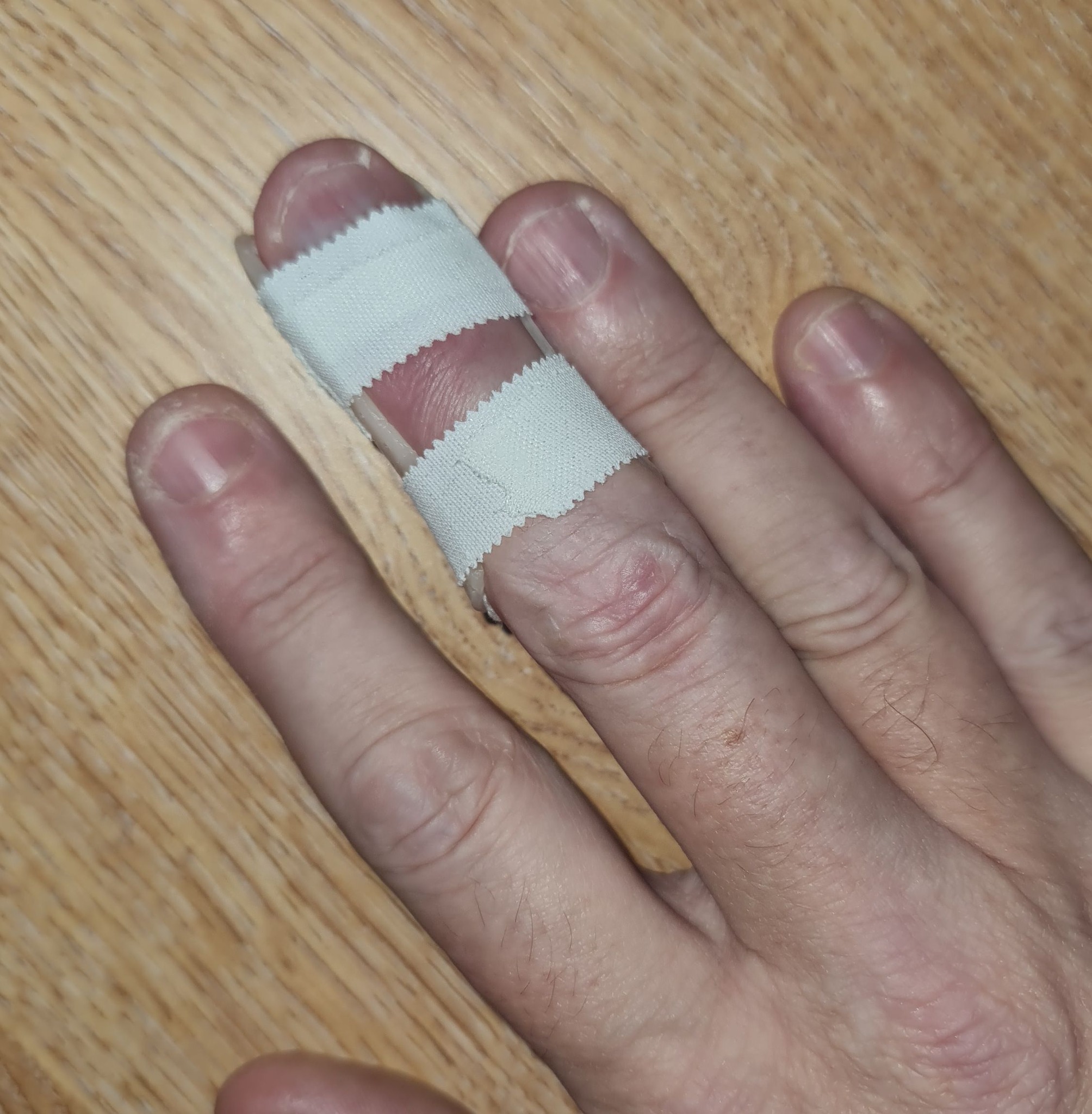 bpc 157 jammed finger Herewith the latest incarnation of the finger. Swelling still there, can't bend the dam and all in all it looks as though any serious playing is off the table for a AOD 9604 