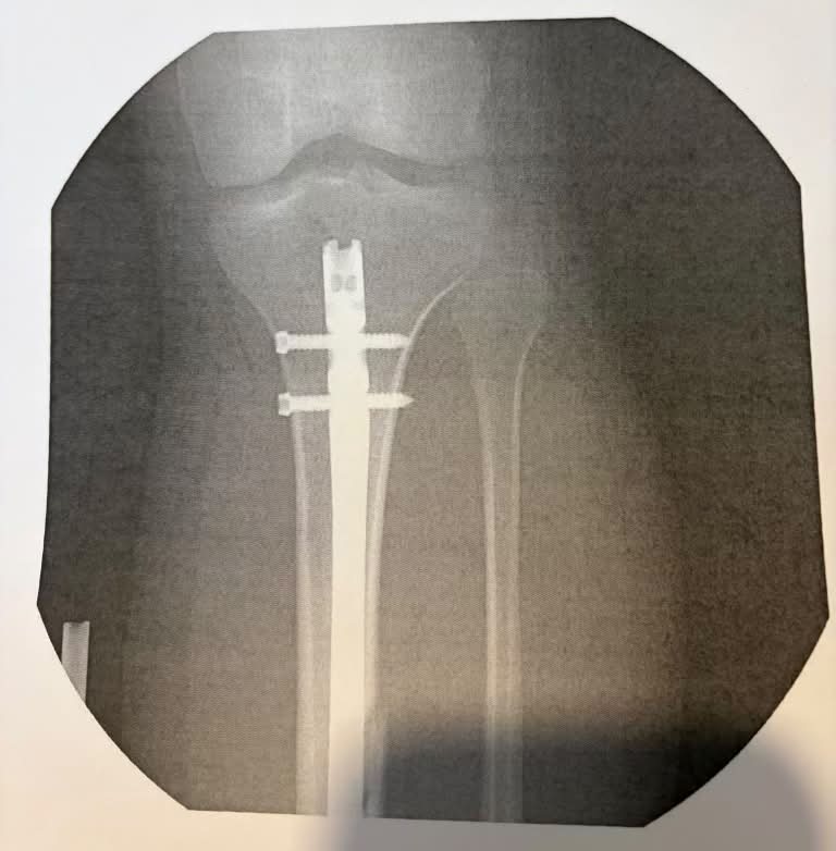 Delete if not allowed. Who has experience with BPC 157/TB 500 to help aid in recovery from a bone break/IM rod fixation surgery? Not asking for medical advice.. just curious on your