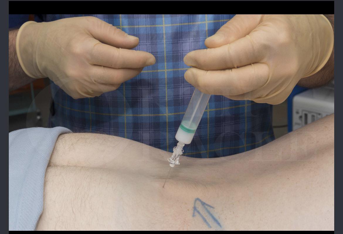 where to inject bpc 157 for herniated disc Lumbar Facet Injection Size x Gauge x Needle Length:3cc 23g x 1 1/2