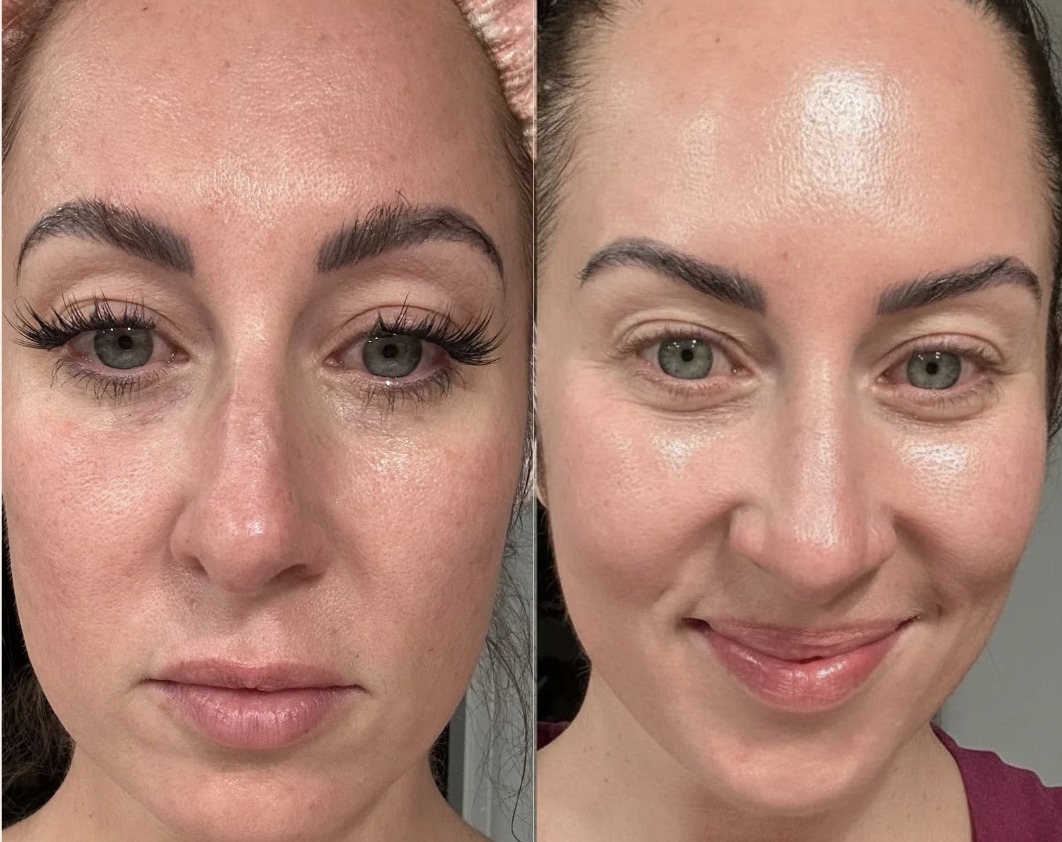 i had acne and scars from steroids. now there GONE! TRETINOIN & GHKCU