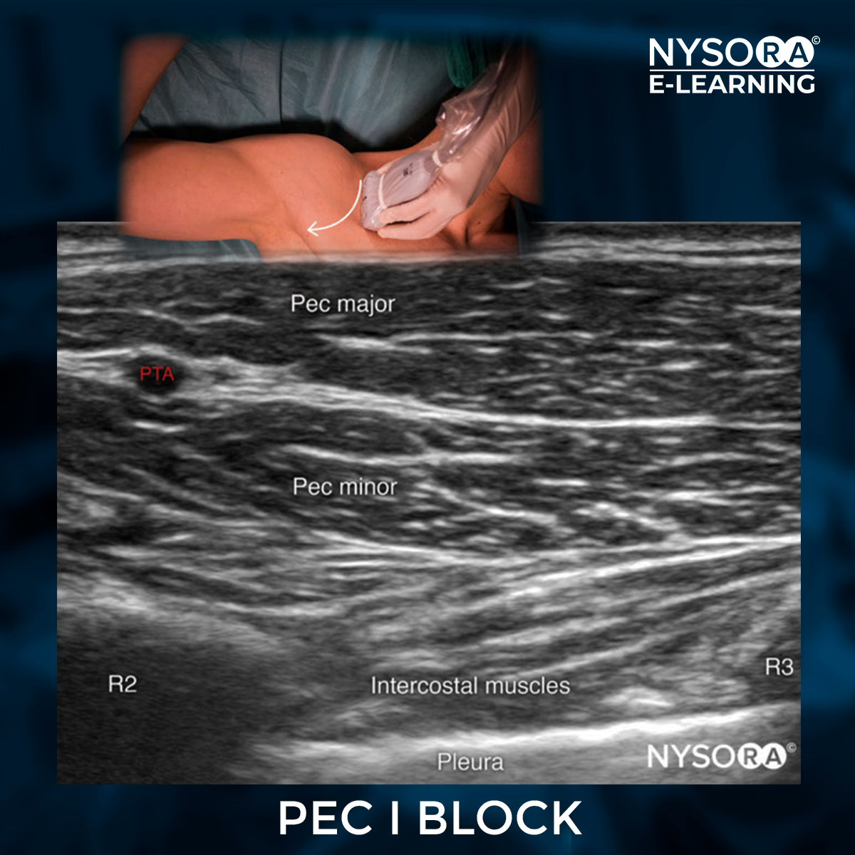 NYSORA - 🔹 Indications for PEC I Block: Analgesia for breast surgery ...