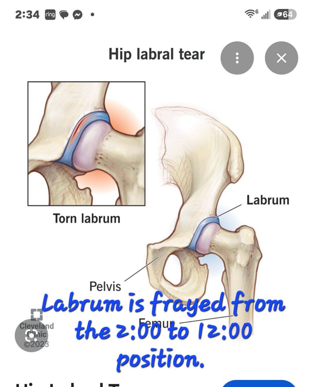 bpc 157 torn labrum What are the options for treating a hip labrum? AOD-9604 5mg - Alt Longevity Research Size:250 mL