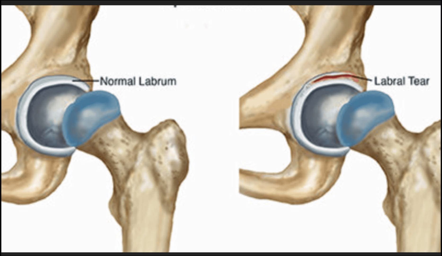 will bpc 157 heal labrum tear What are alternatives to surgery for healing a torn hip labrum? deficiency Size:30mL Vetoquinol Vitamin B12 5000