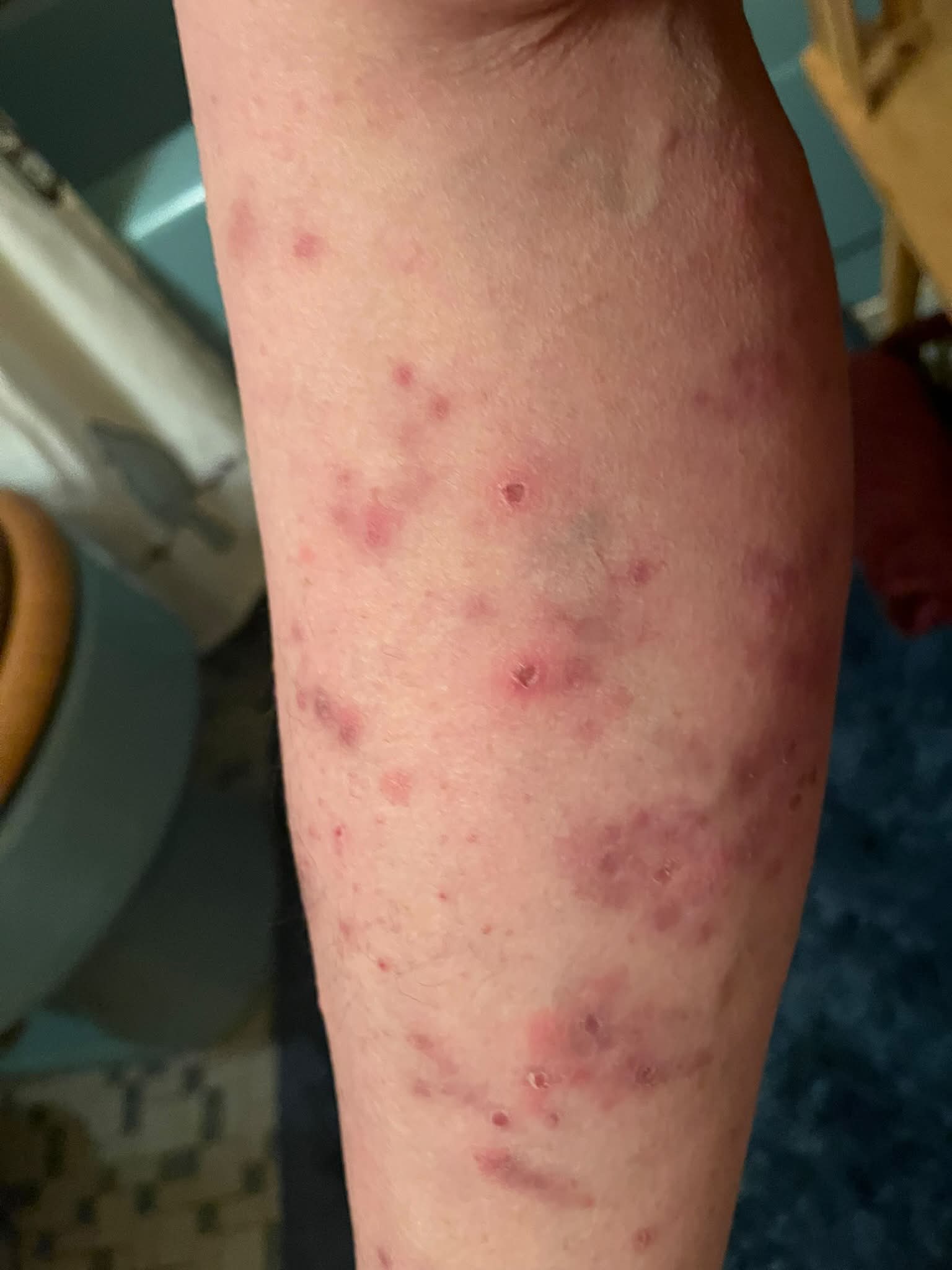 acetyl l carnitine skin rash A 30 years old gentleman previously healthy. Developed this after strict diet program. Diagnosis? Meet WOLVERINE from Push after care cream for fibroblast Size:TWIN PACK 30 Caps
