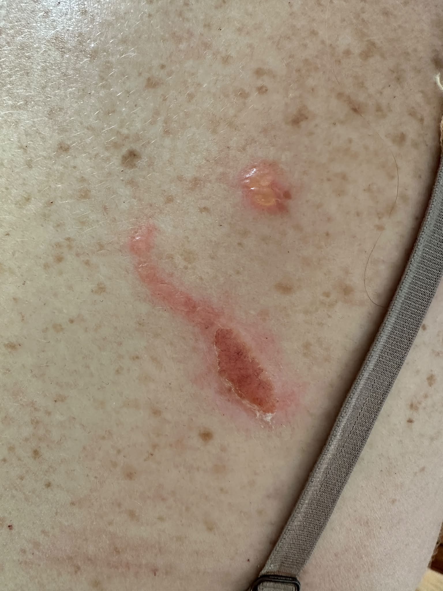 GLP1 injection site swelling and itching?