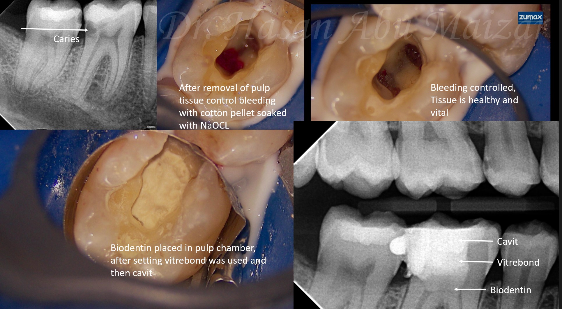 Vital pulp therapy replacing root canal treatment for irreversible