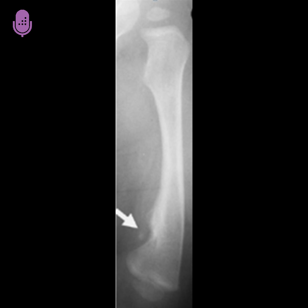 Orthobullets - Focal fibrocartilaginous dysplasia (FFCD)... | Facebook
