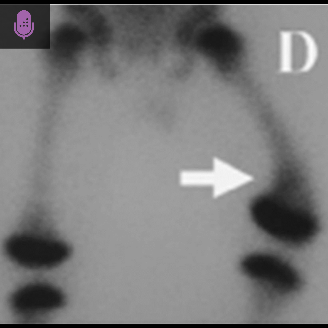 Orthobullets - Focal fibrocartilaginous dysplasia (FFCD)... | Facebook