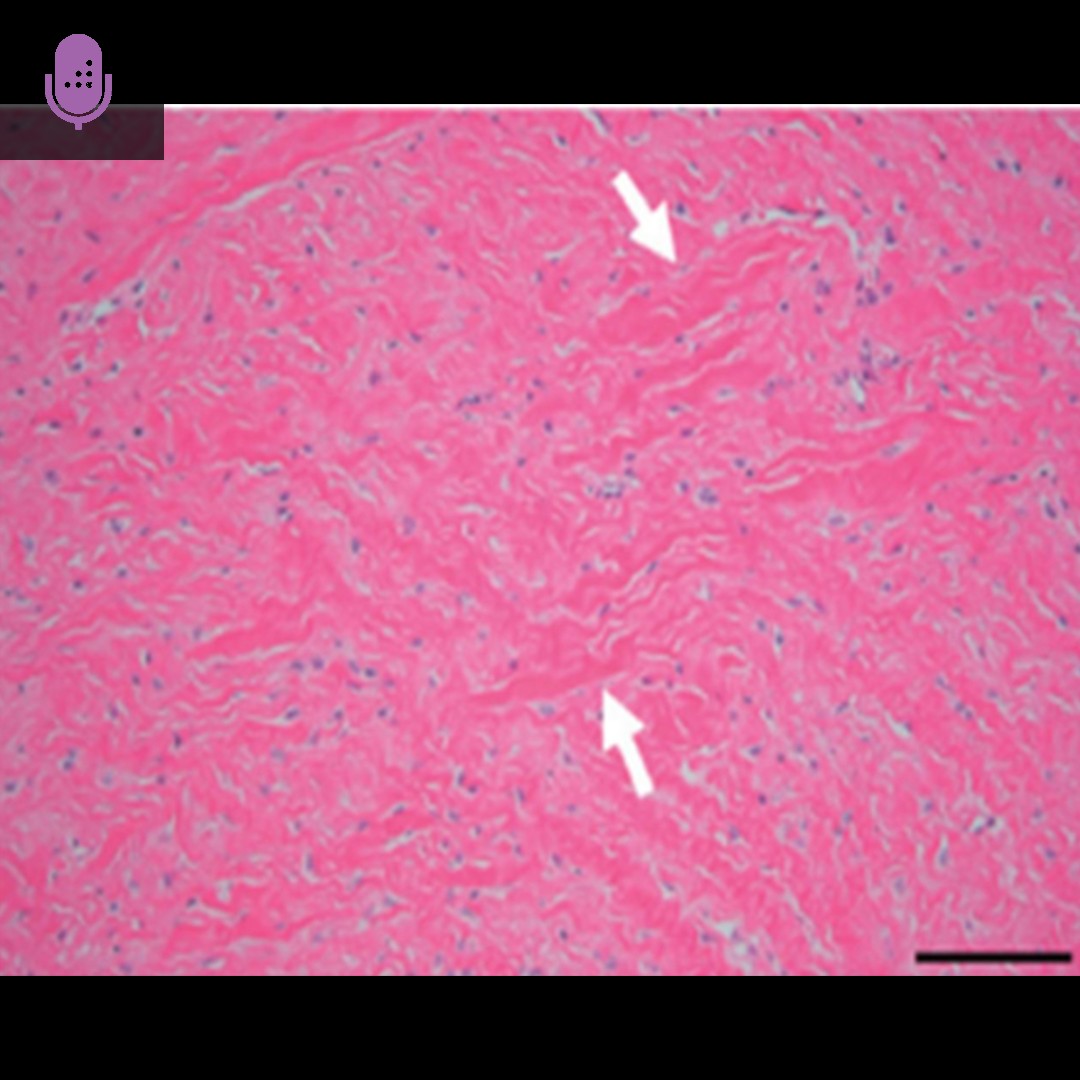 Orthobullets - Focal fibrocartilaginous dysplasia (FFCD)... | Facebook