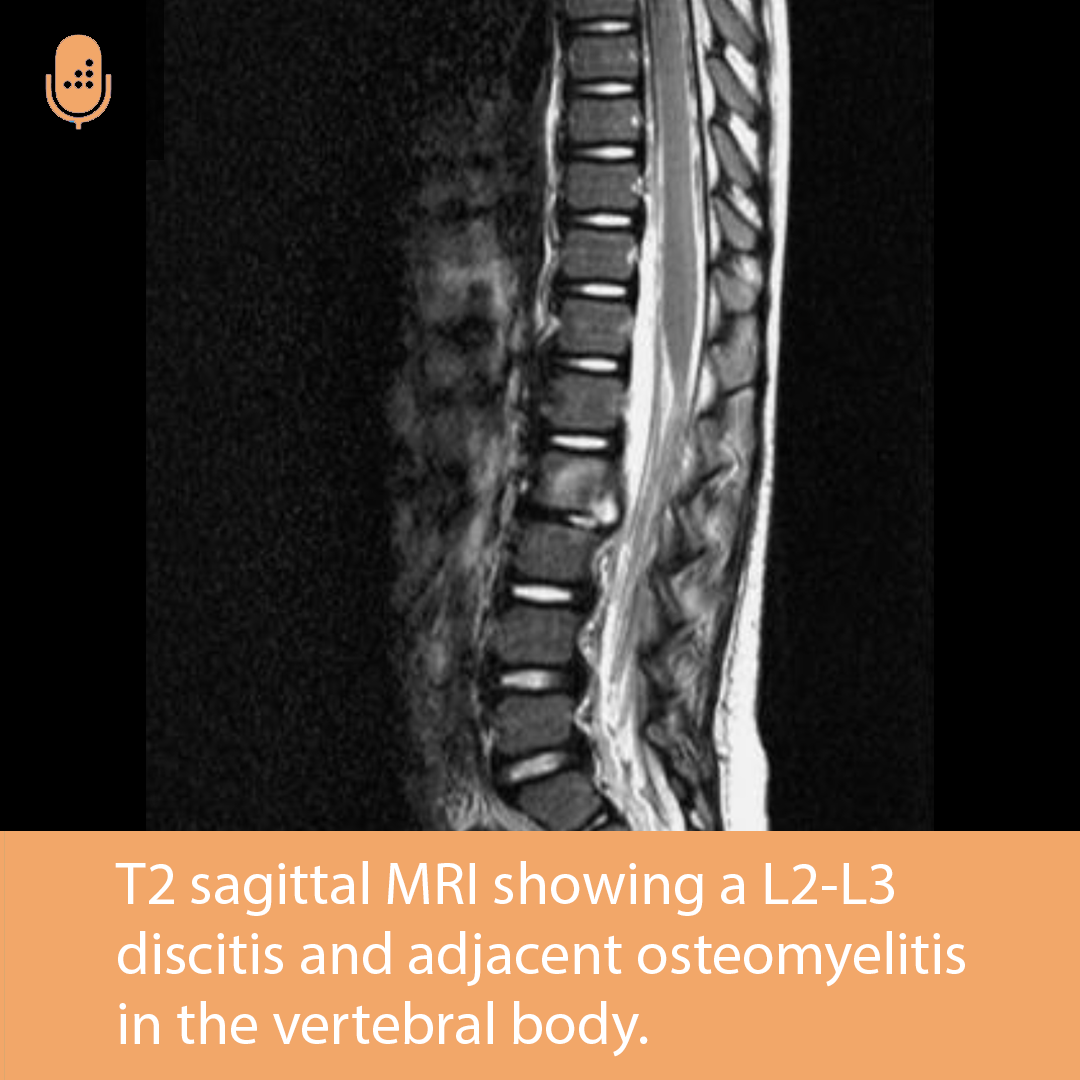 Orthobullets - Clinical presentation of pediatric discitis... | Facebook