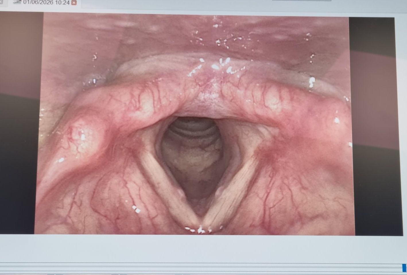 glutathione and vocal cord polyps or nodules: symptoms workarounds? مكمل لنضارة البشرة Patch Placement Guide Page size:30-day servings