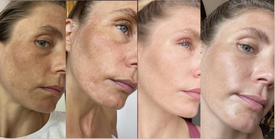 Melasma treatment with Glutathione Before and after result