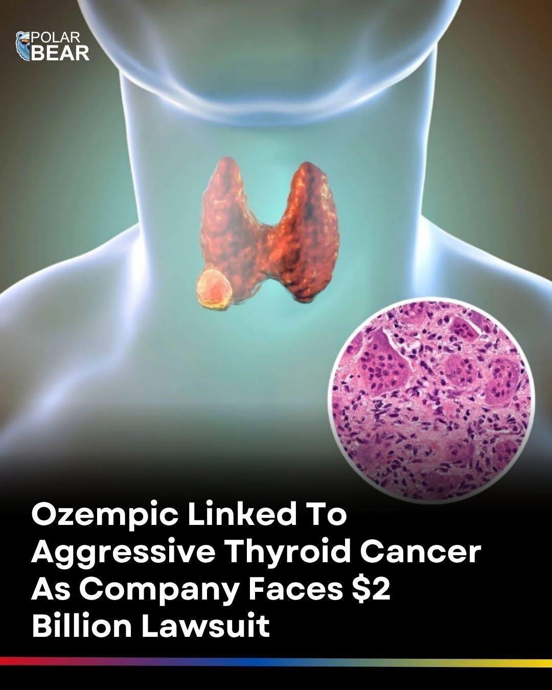 Has anyone else gotten Thyroid cancer after being on Ozempic or another Semiglutide med? My Endrochronologist told mebthe cancer is have Folicular (i know i spelled that wrong) is not from Ozempic....but
