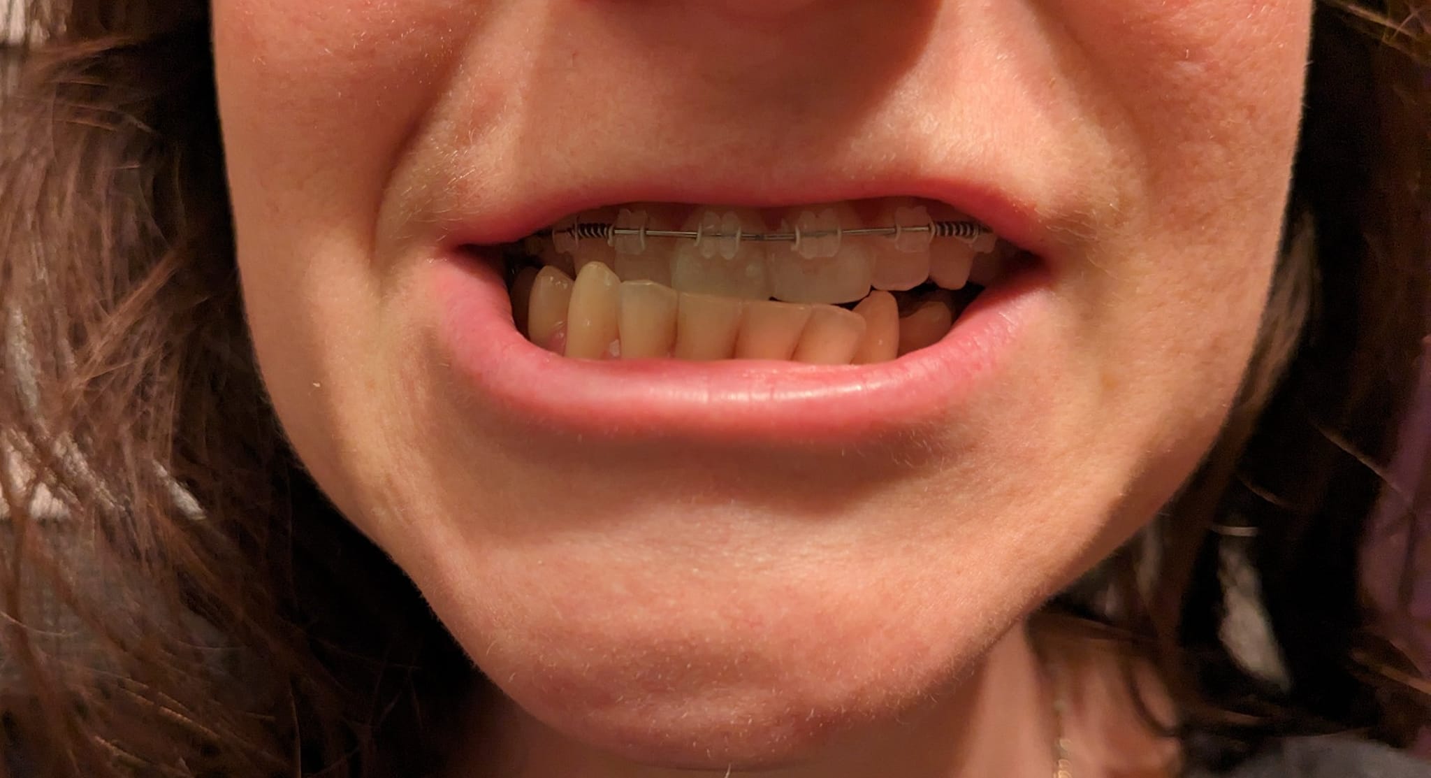 klower lip twitches reddit TMJ splint dependency and jaw progression before surgery Wastegate Options::On3 Performance 44mm Wastegate Lipo-Mino + L-Carnitine Injection, Dua Designer Line