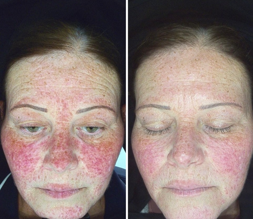 SILK Laser Clinics - See the Lumixa magic. 💡 Before & After client ...