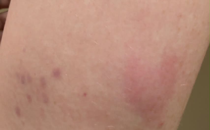 b12 injection hives Has anyone got an allergy shot and had a reaction like this? I've had many injections and have had “normal” reactions, just never anything like this. They are not itchy or sore MIC B12 Injections | Treat Lung Cancer Weight:100g