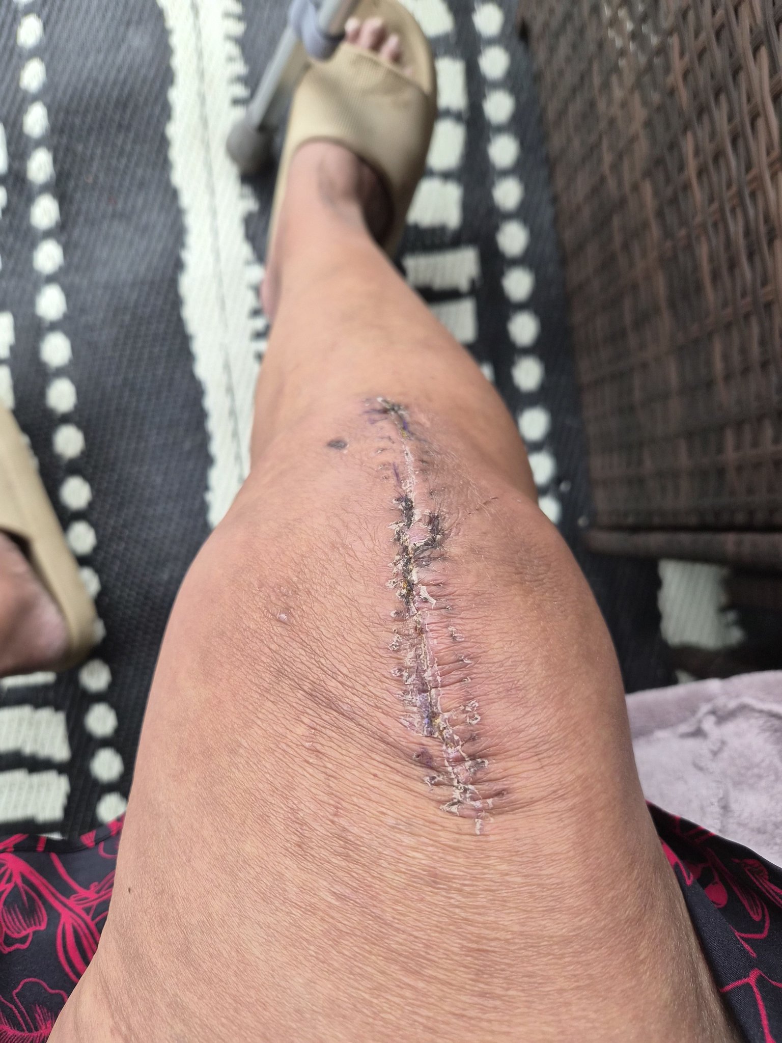 Morning guys I am having my second knee operation 1st October.... has anyone used or know about BPC 157 which apparently aids recovery .... TIA
