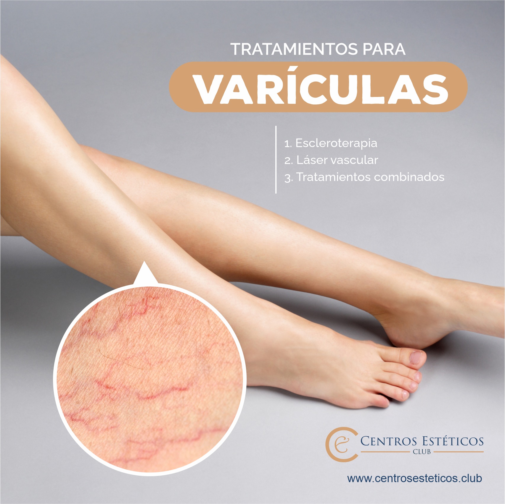 📌Las varículas conocida también... - Centros Estéticos Club | Facebook