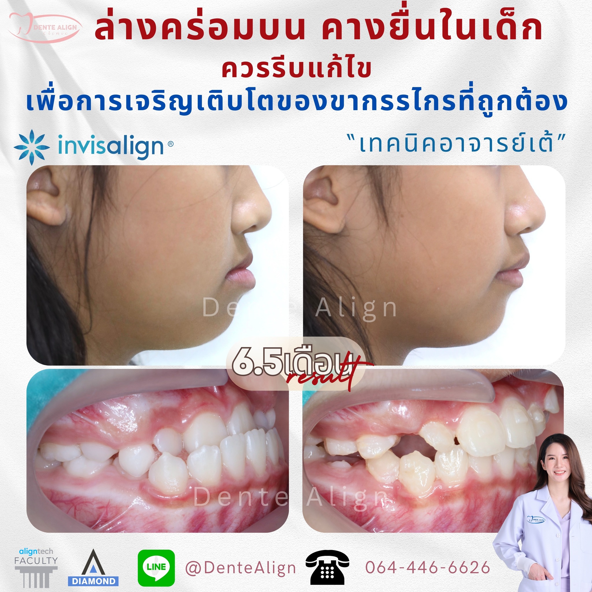 🎉🎉คางยื่... - Dente Align Clinic - Invisalign Diamond Provider | Facebook