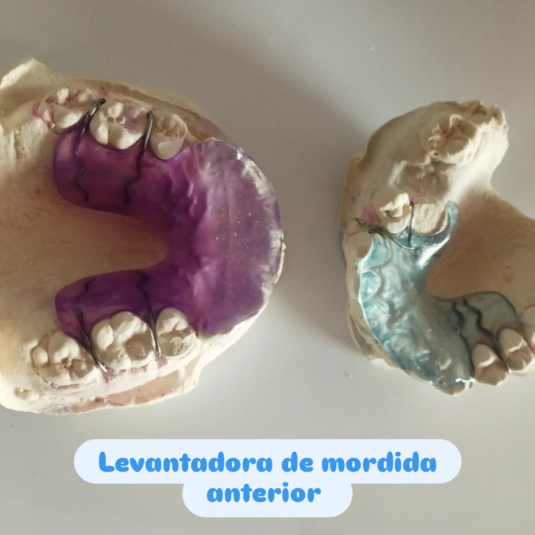 ACTIFORMS - Placa expansión con rejilla #ortodoncia #aparatologia # ...