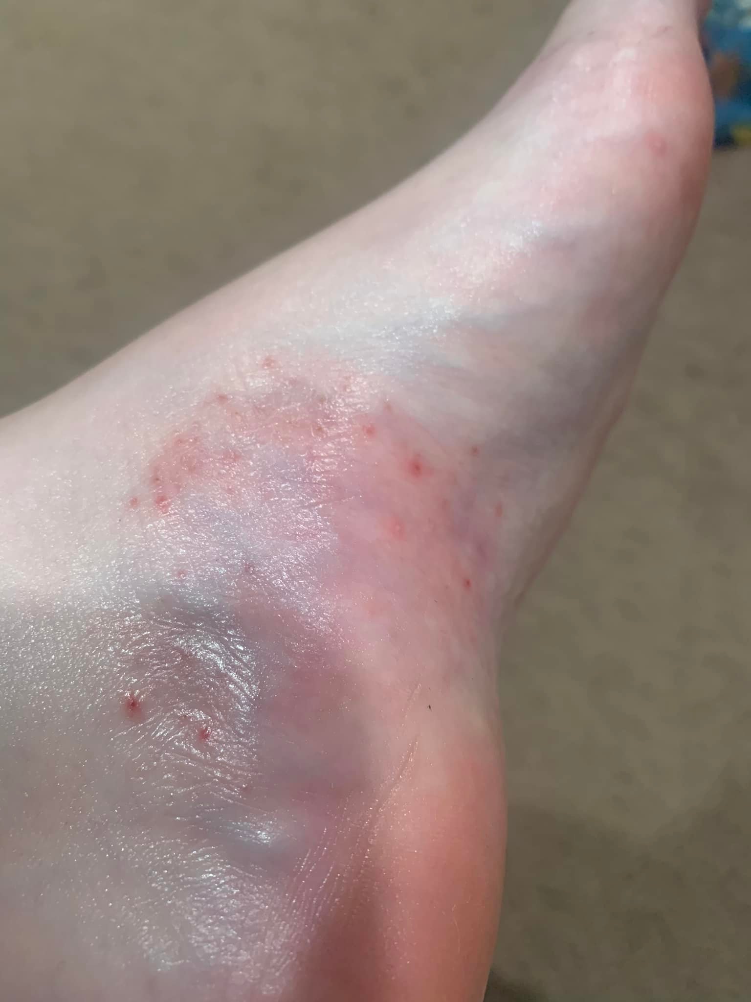 l carnitine skin rash Supplement causing red on skin? BAC Water 30mL - Active Lifestyle Quantity:15ml