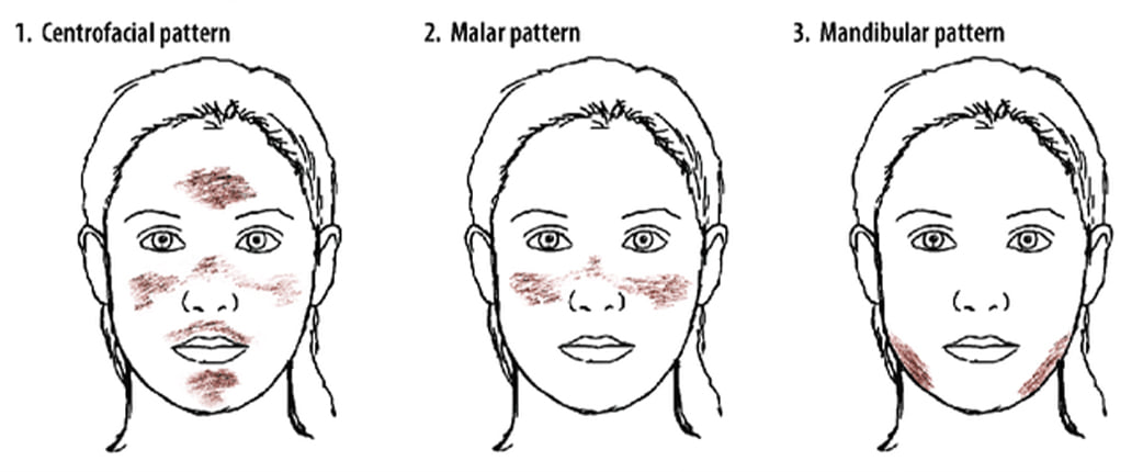 📌 COMMON PATTERN... - Top.1 Melasma Cream - Vita Perfect Skin