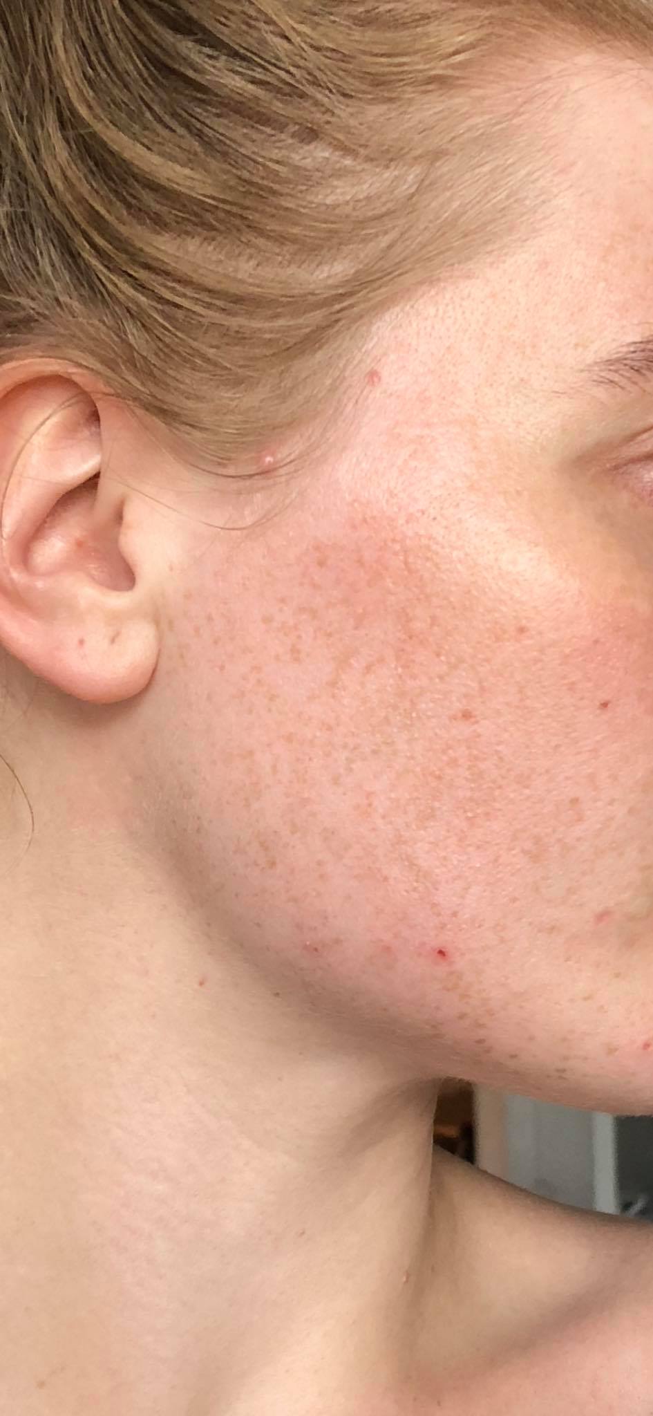 melanotan nasal spray dosage Freckles, Birth Marks & Port Stains main image 0