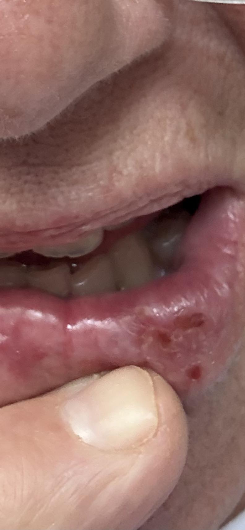 Severe side pain while taking tirzepatide?