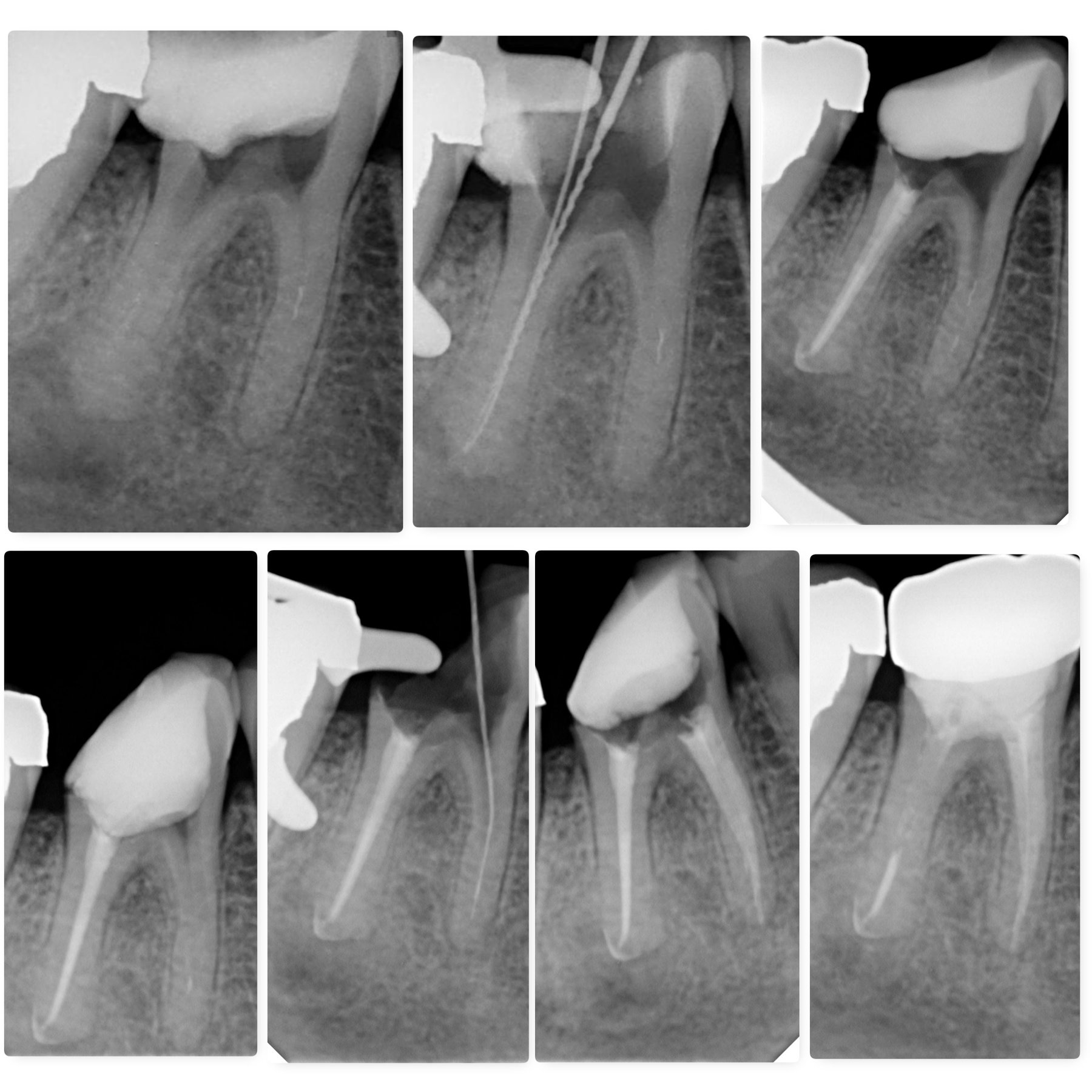 Style Italiano Endodontics | # this case referred to me for management ...