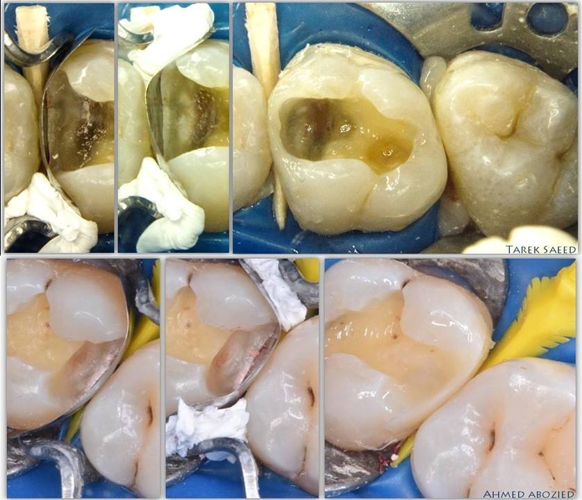 Bandes Matrices Dentaires Tofflemire - Pour Restauration Et élévation De Courbure - Neuves