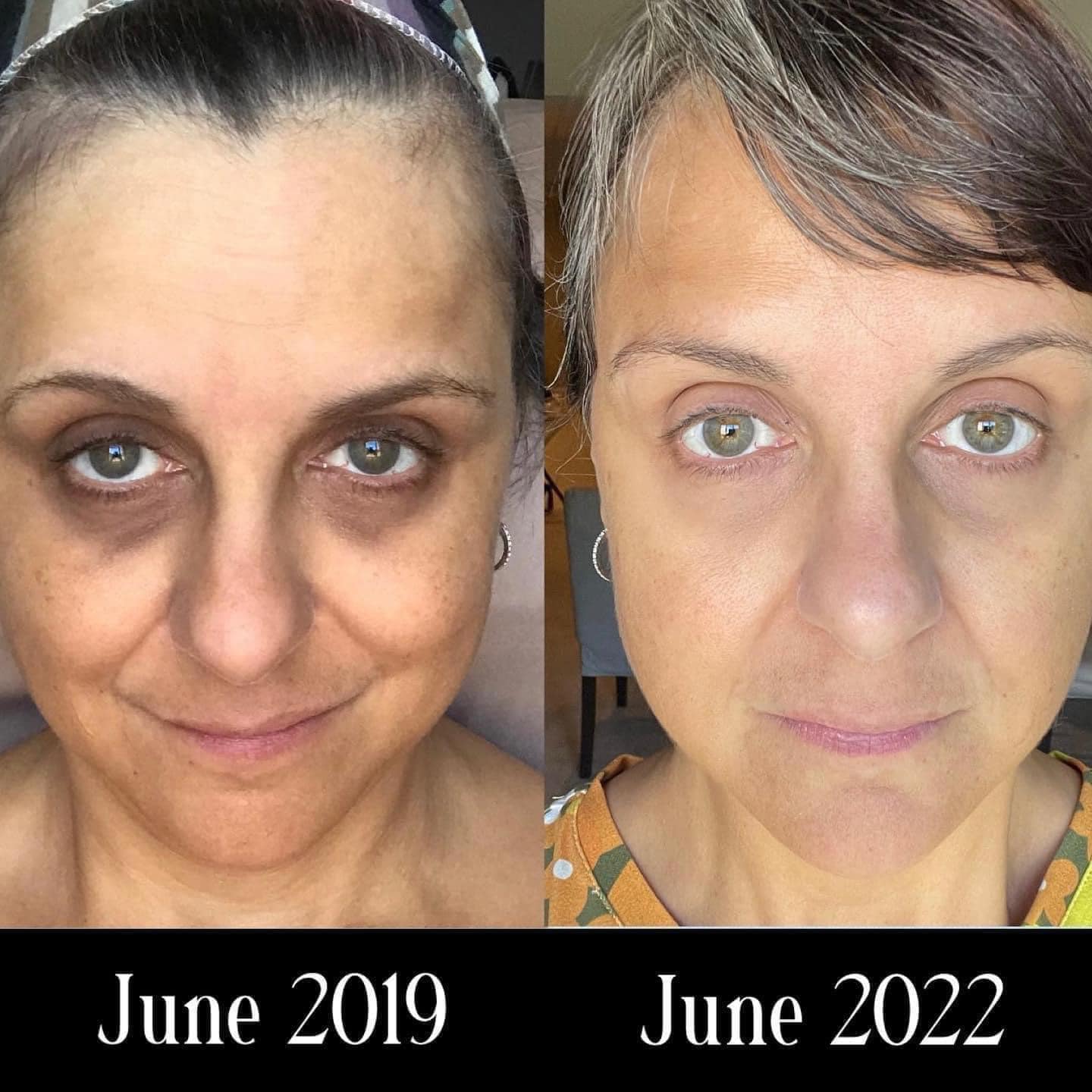 This patient has achieved amazing results in only 3 months!!! We absolutely just love her glow 😍❤️ @glutathione.sa