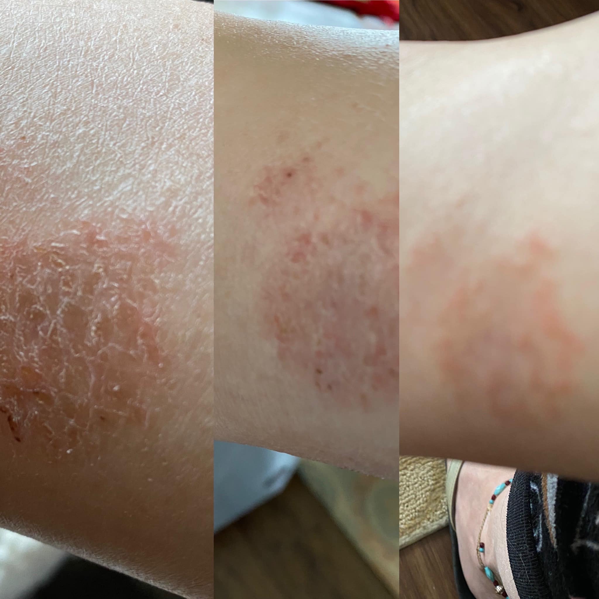 rashes after taking glutathione Glutazol injection lotion review SIZE::30 ml / 1 oz Relumins RLGLUTA1000 Advance Nutrition SunshineNutrition