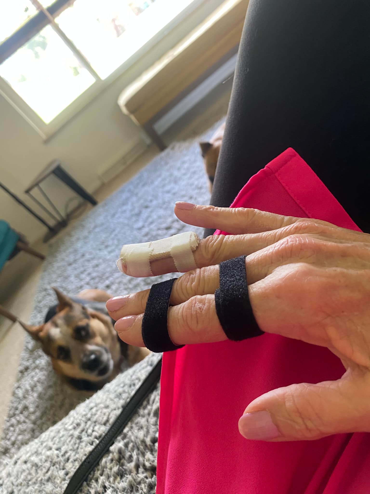 Mallet finger injury recovery experience